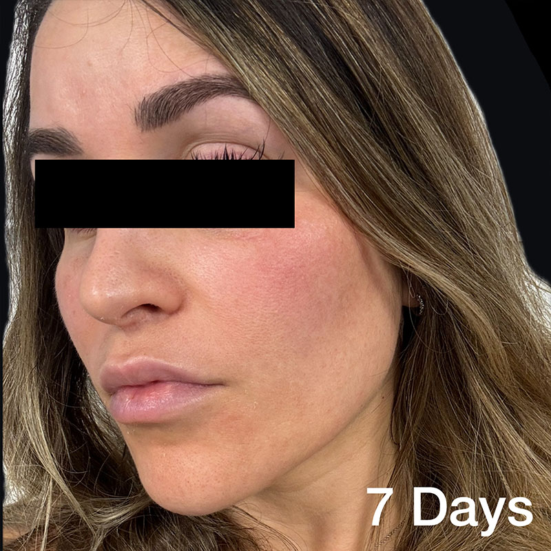 coolpeel-7-days-a